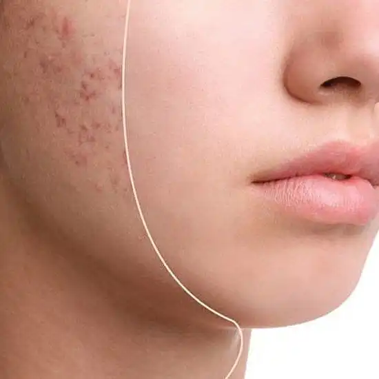 Acne Treatment